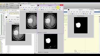 Brain Tumor Detection and Classification Using Matlab | Brain Tumor Prediction Analysis