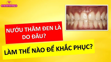 Làm thế nào để khắc phục nướu thâm đen | Tt niềng răng quốc tế Diamond