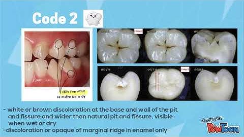 ICDAS and classification of caries