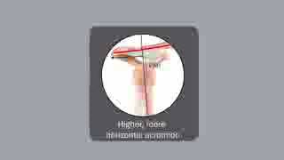 Posterior Acromial Morphology Is Significantly Associated with Posterior Shoulder Instability
