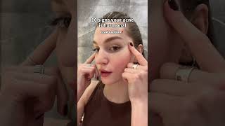 If acne keeps coming back in the SAME places... it might not be your routine. #hormonalacne #acne