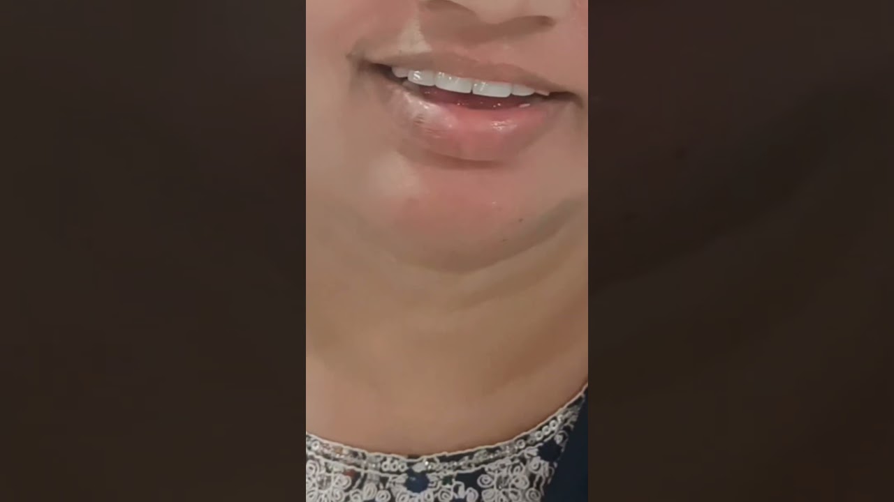 Single Visit Smile Designing at ELEDENT Dental Hospital | Best Dental Hospital In India | 