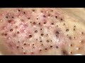 Blackhead removal with sac dep spa 10007084