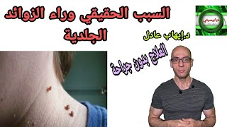 108. السبب الحقيقي وراء الزوائد الجلدية| العلاج بدون جراحة !!!