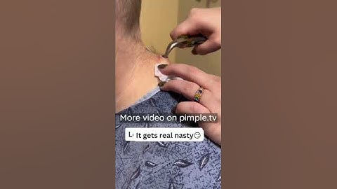 Never squeeze acne with your hands.