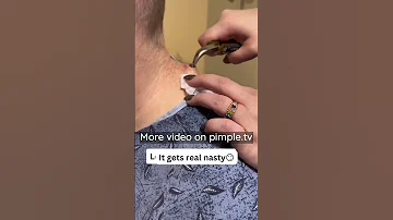 Never Squeeze Acne With Your Hands 