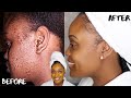 HOW TO GET RID OF ACNE SCARS AND DARK MARKS FAST | DIY TURMERIC, HONEY, LEMON, AND ALOE FACE MASK