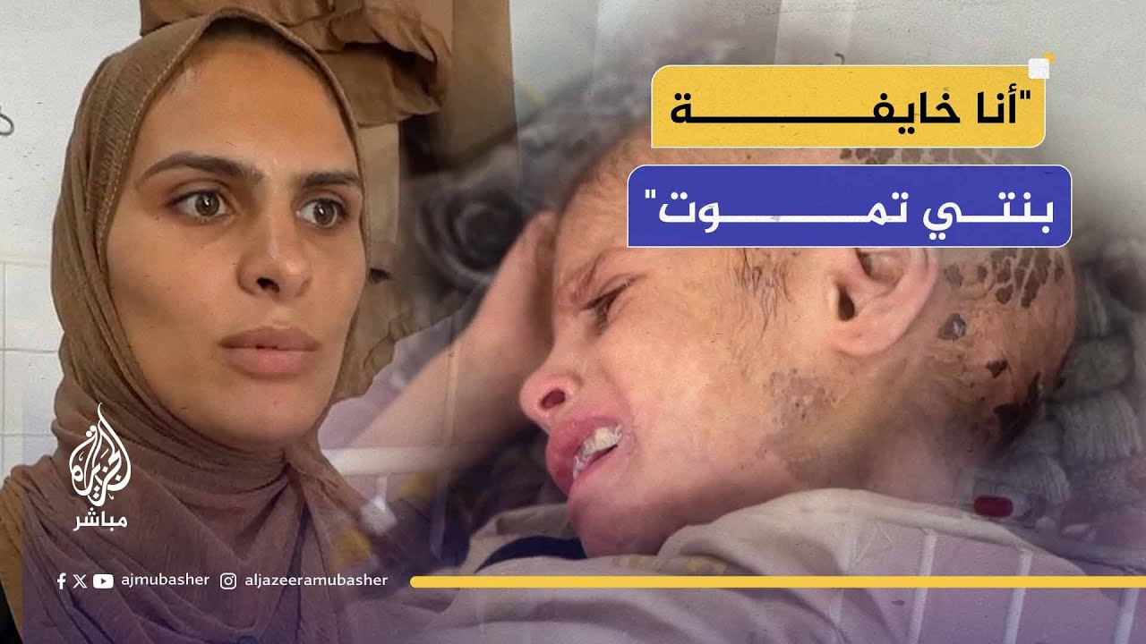 تساقط شعرها وفقدت القدرة على المشي.. سوء التغذية يفتك بالطفلة مي أبو عرار