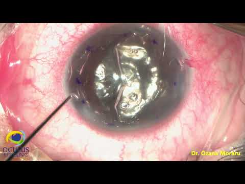 Endo-in preloaded DMEK surgery via pull-through technique, in pseudophakic bullous keratopathy eye.