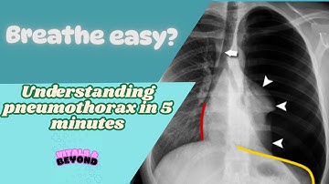 Pneumothorax Explained: Causes, Symptoms & Emergency Treatment