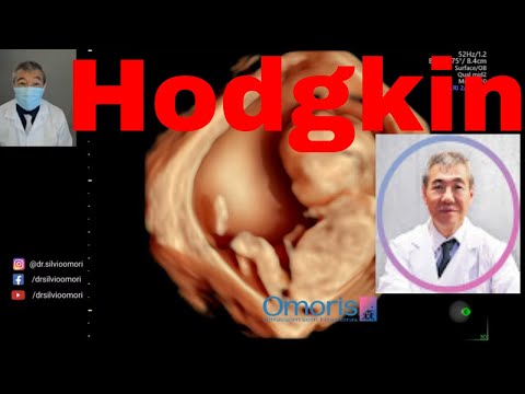 Non-Hodgkin Lenfoma - 14 haftalık gebelik