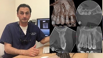 3-D Imaging in Endodontics: What, Why, and When
