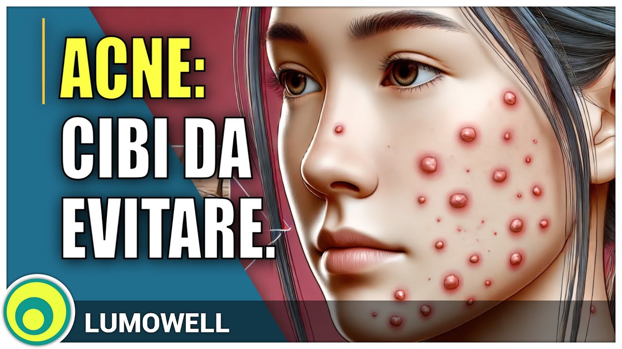 Acne: Cibi Da Evitare - YouTube