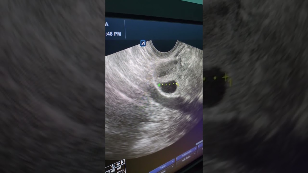 كيف نقيس حجم البويضة المناسب للحمل