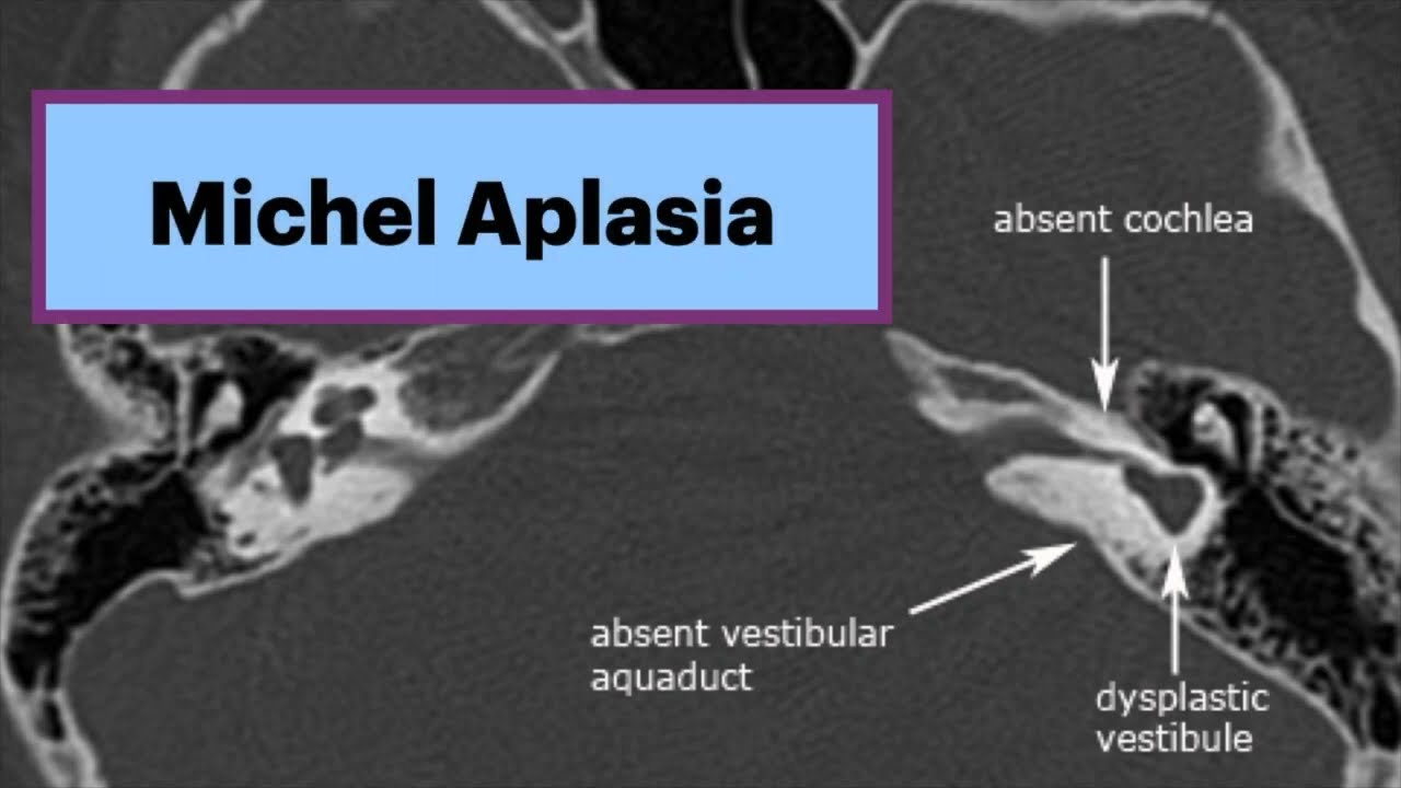 Michel Aplasia - Complete Labyrinthine Aplasia Radiology 