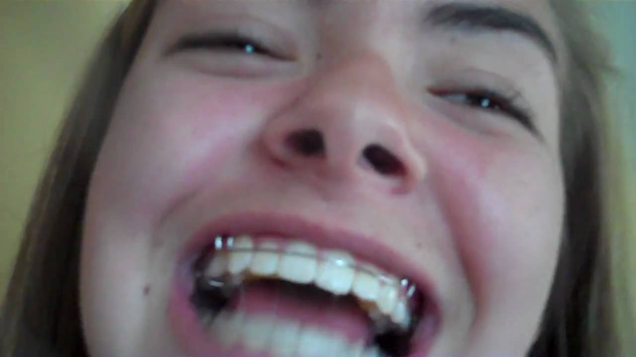 braces retainers got sister nicole
