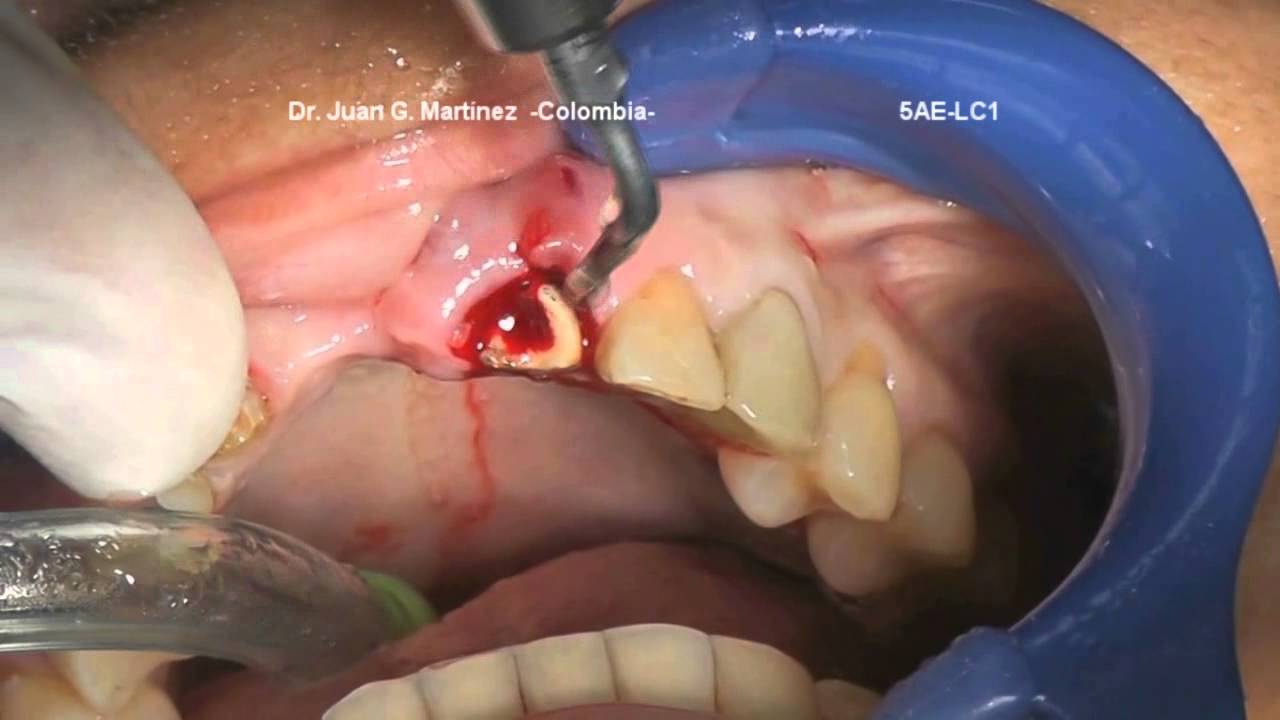 ⁣Crown Removal with 5AE-Tip & Tooth Extraction with LC1-Tip (Dr_Juan_Martinez)