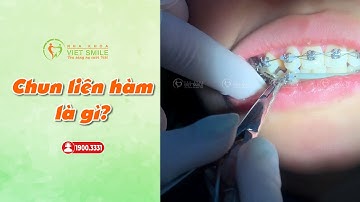 Thun liên hàm trong niềng răng có tác dụng gì? Cận cảnh đeo chun