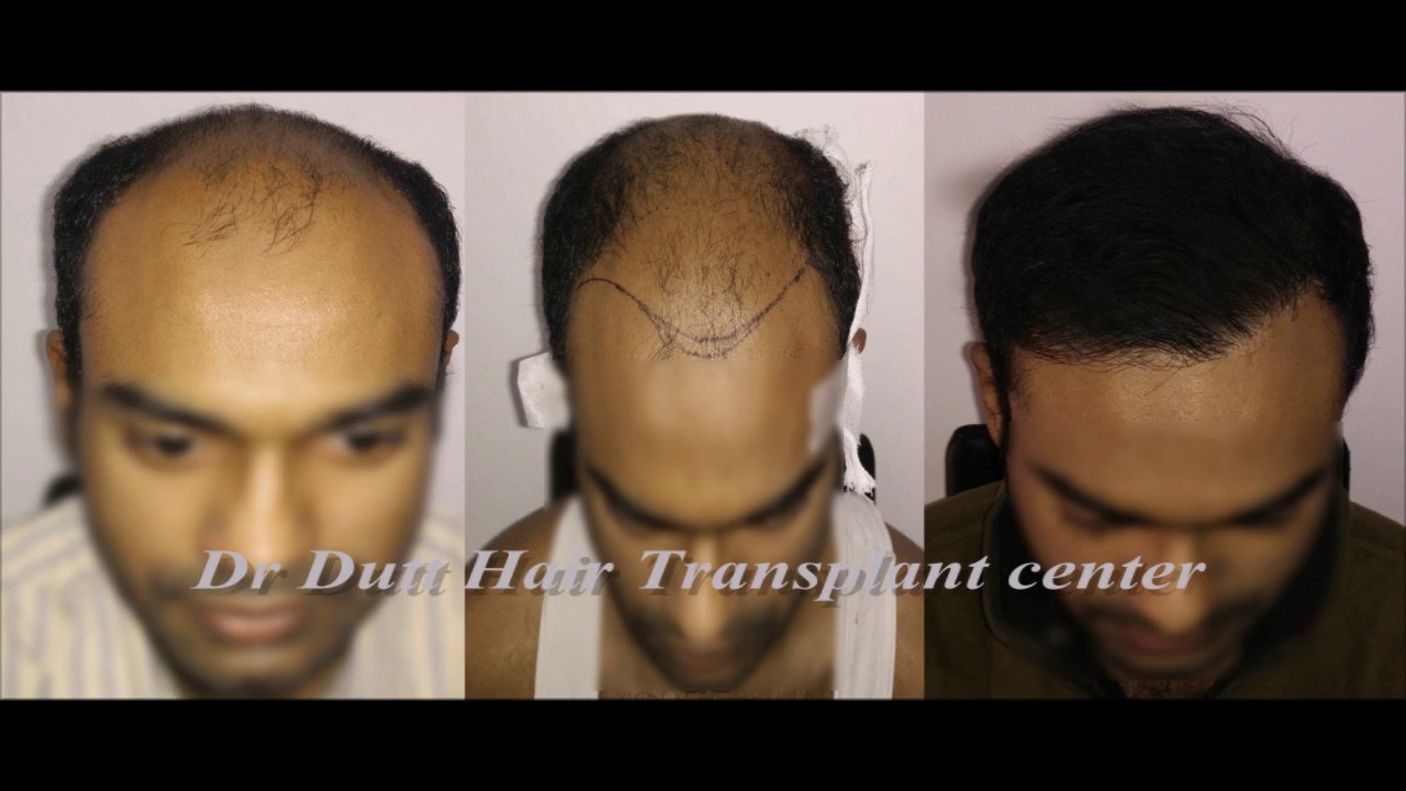 We provide State to The Art Hair Transplant Exclusively in FUE Hair transpl...