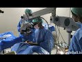 Icl surgery  with the ophthall pro microscope