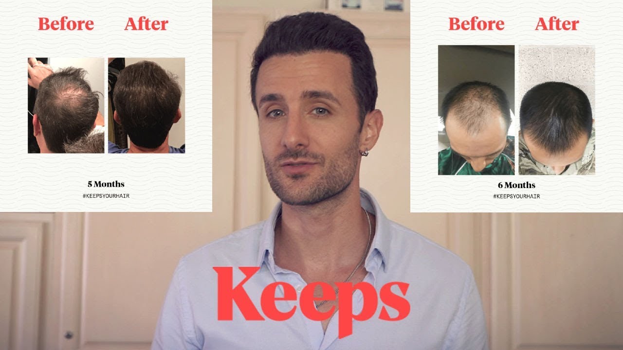 Keeps Hair Loss Review | Easiest Way To Stop Hair Loss - YouTube