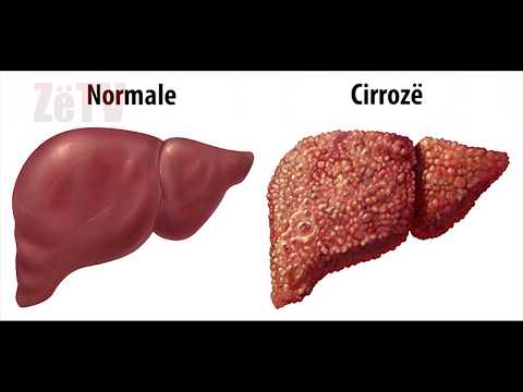 Cirroza hepatike e mëlçisë - "Kuriozitete e këshilla mbi shëndetin"