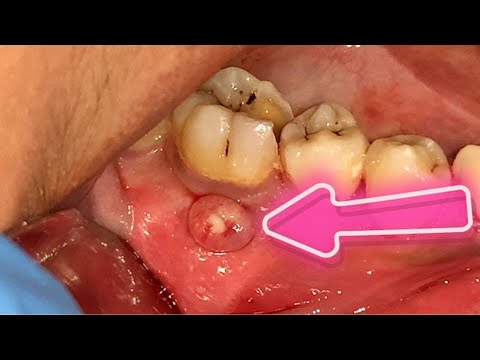 Video: Apakah itu fistula gigi?