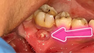 Very Satisfying To Pop The Dental Abscess Out | Dentist | Dokter Gigi Tri Putra