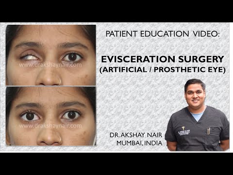 Video: Protetické Oko: Náklady, Starostlivosť, Chirurgia A ďalšie