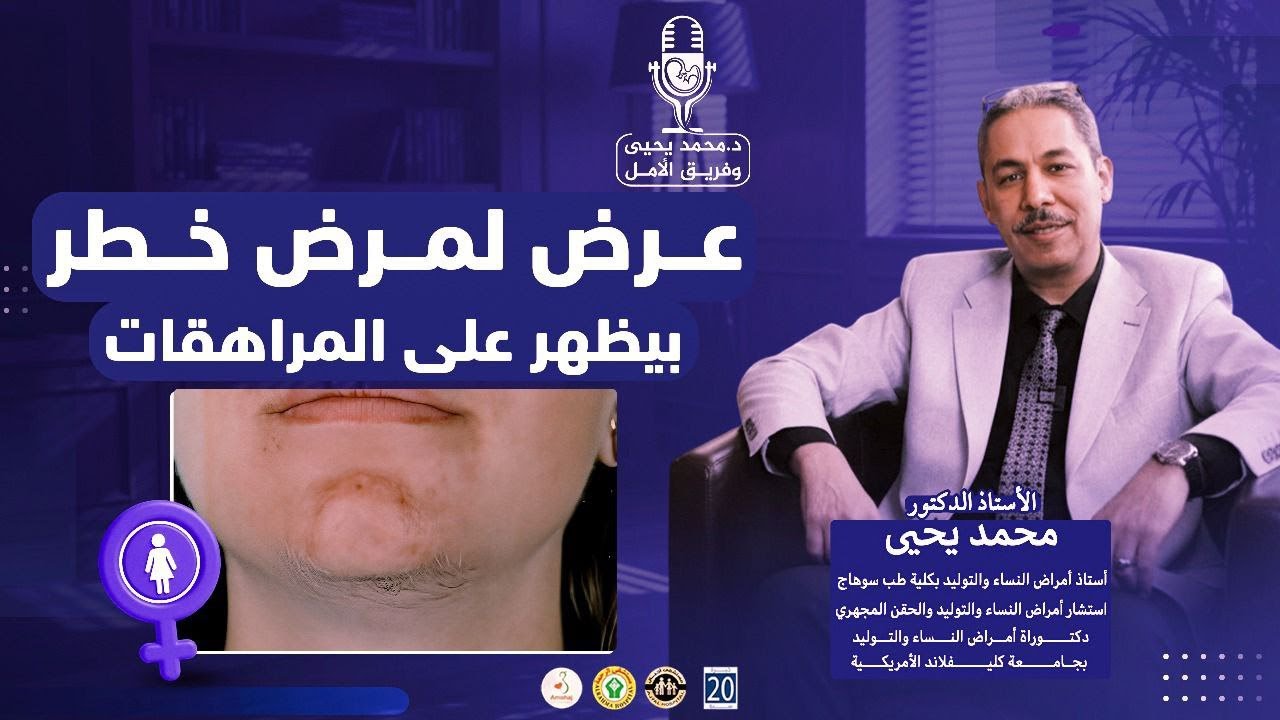 شعر الدقن للبنت قد يشير لمرض خطير