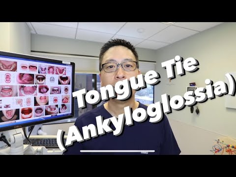 Tongue Tie or Ankyloglossia: when to we clip it (frenum, frenulum, frenulectomy, frenulotomy)