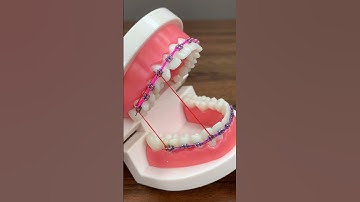 Niềng răng mắc cài chun #niềngrăng #dentist #orthodontist #niengrang
