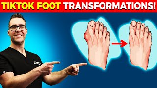 Expert Podiatrist Reviews Crazy TikTok Foot Transformations!