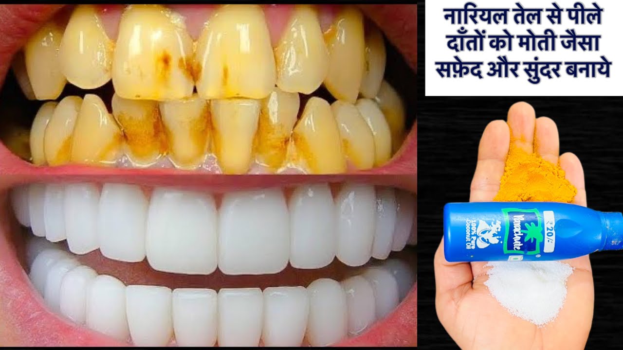 सिर्फ़ एक मिनट में दाँतों का पीलापन दूर करके पाएँ मोती जैसे चमकदार दाँत