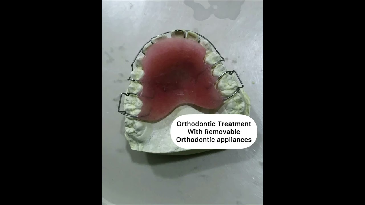 Orthodontic Treatment With Removable Orthodontic appliances Britanna Dental Clinic kandy