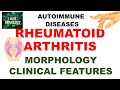 RHEUMATOID ARTHRITIS  |MORPHOLOGY, CLINICAL FEATURES &amp; DIAGNOSIS