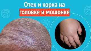 😲 Отек и корка на головке и мошонке. Клинический случай №1245