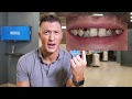 Dentist says DO NOT CROWN YOUR TEETH! - Proves it with a Clinical example!