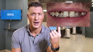 Dentist says DO NOT CROWN YOUR TEETH!  Proves it with a Clinical example!