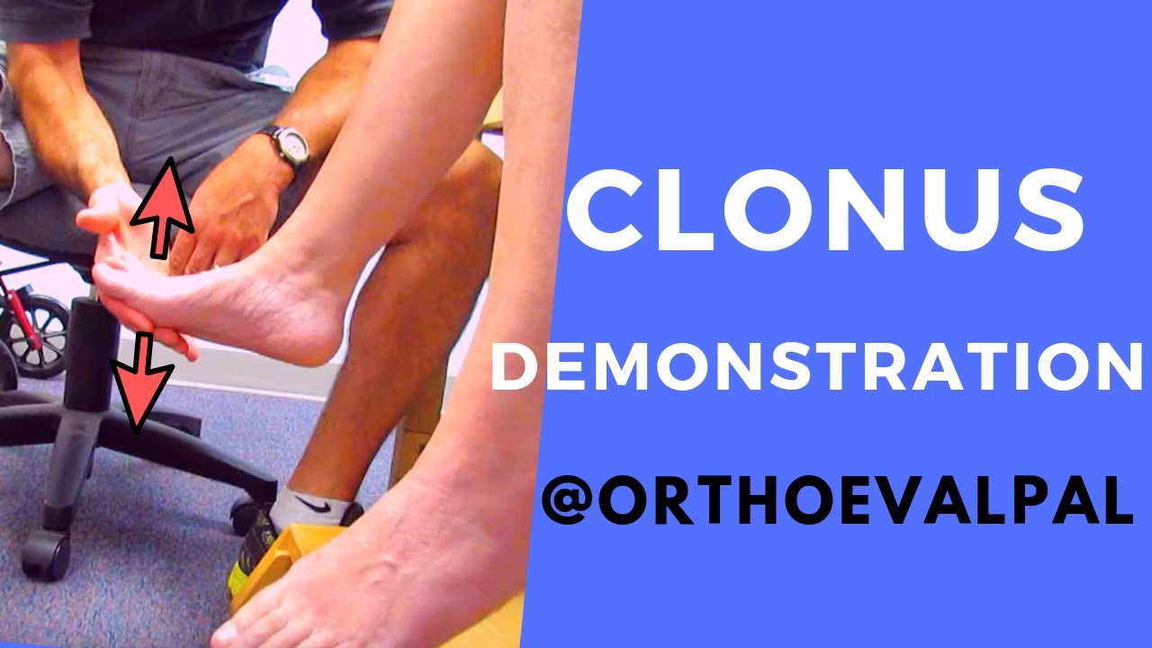 Clonus Demonstration with Ortho Eva Pal