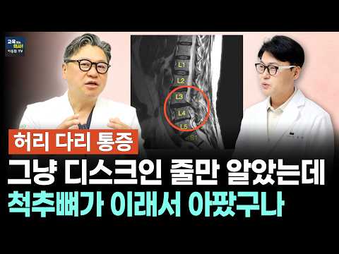 단순 허리디스크가 아닙니다. 5분도 걷기 힘든 허리 다리 통증의 진짜 원인 (척추전방전위증 치료 사례)