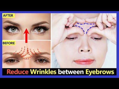 Video: 5 tehokkaita tapoja päästä eroon forehead wrinkles