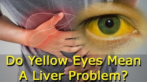 Do Yellow Eyes Mean Liver Damage?