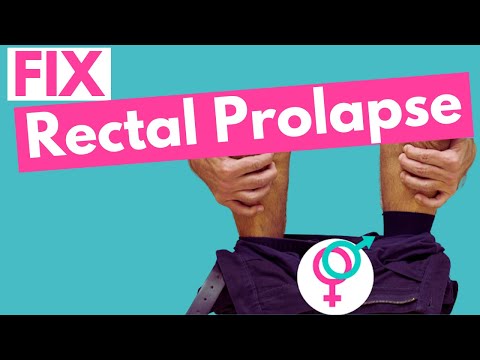 Video: Abdominal Prolaps Før Fødsel