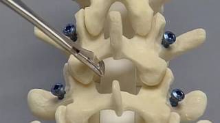 Posterior Lumbar Interbody Fusion PLIF (spine surgery)