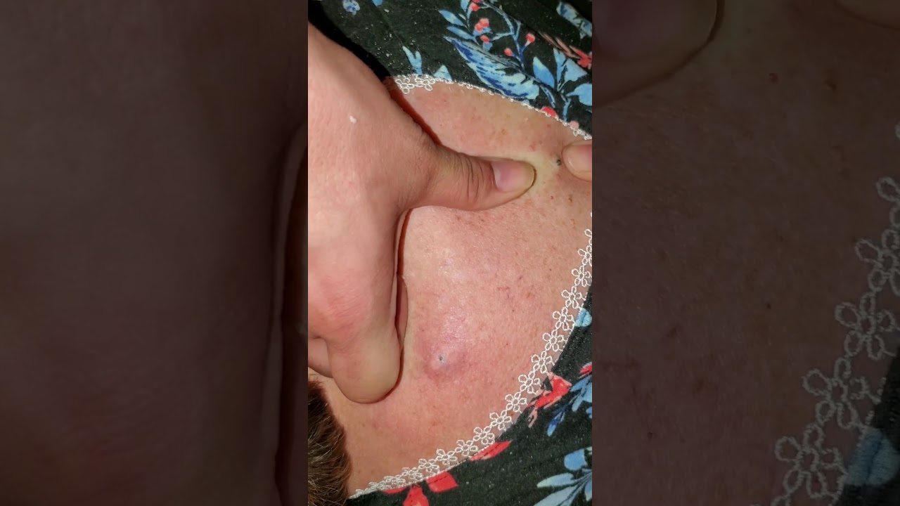 25 Best Pimple Popping Videos Gross Pimple Pop Videos 21