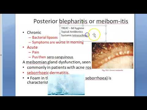 Video: Meibomitis: Ursachen, Behandlung, Diagnose, Prävention Und Bilder