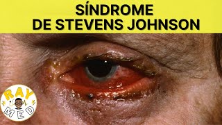 Síndrome de Stevens Johnson (Parte 2): Manifestaciones, diagnóstico y tratamiento.
