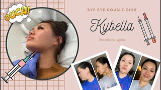 Kybella | Watch how I got rid of my double chin! #kybella #notabeautyguru
