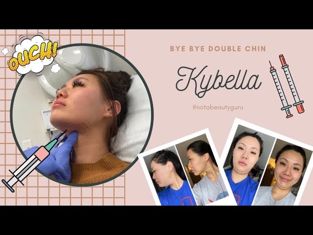 Bra Fat Be Gone: Destroy Excess Fat With Kybella: Rostami OPC